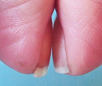 Unhas